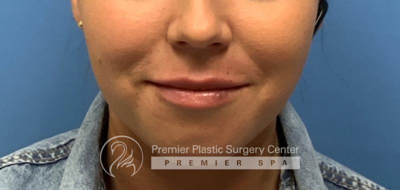 Lip Augmentation Before & After Image