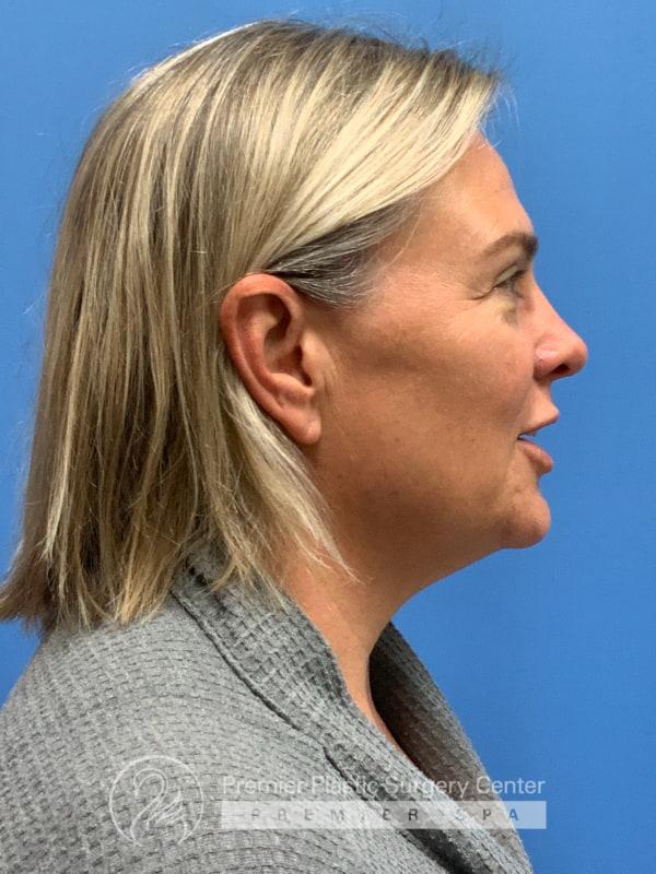 Neck Lift Before & After Image