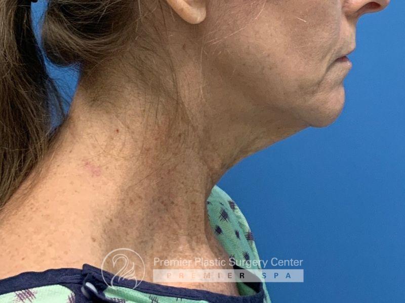 Neck Lift Before & After Image