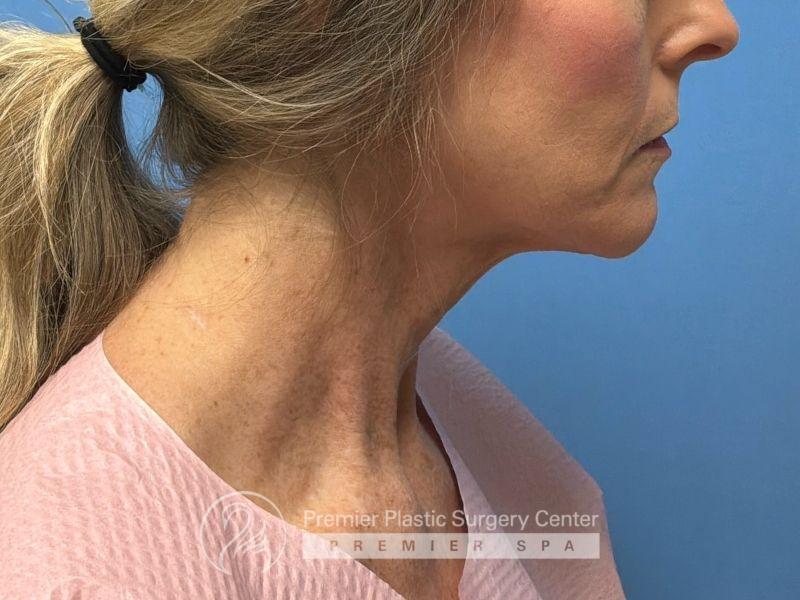 Neck Lift Before & After Image