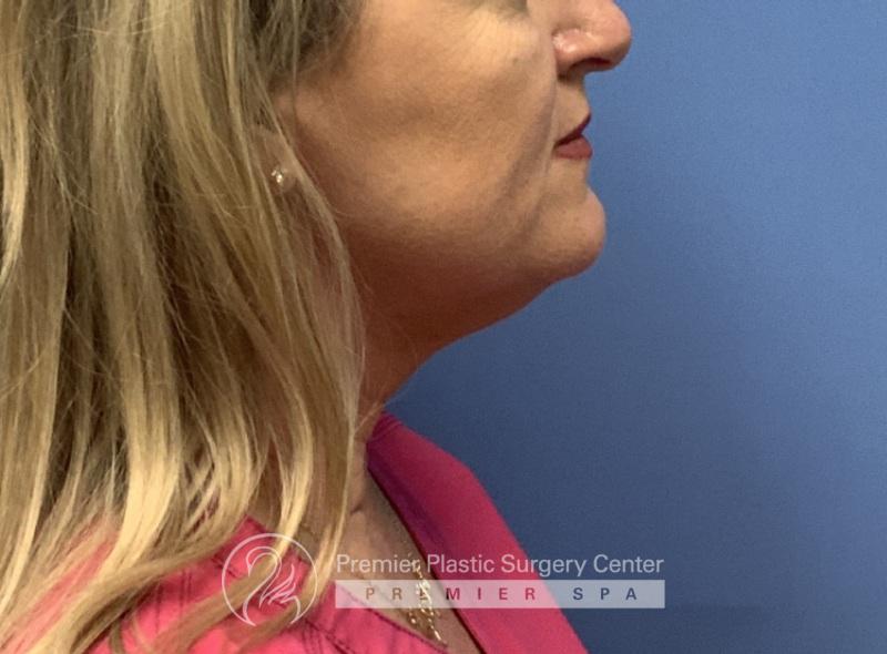 Neck Lift Before & After Image