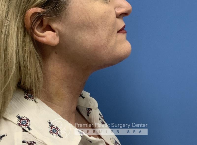 Neck Lift Before & After Image