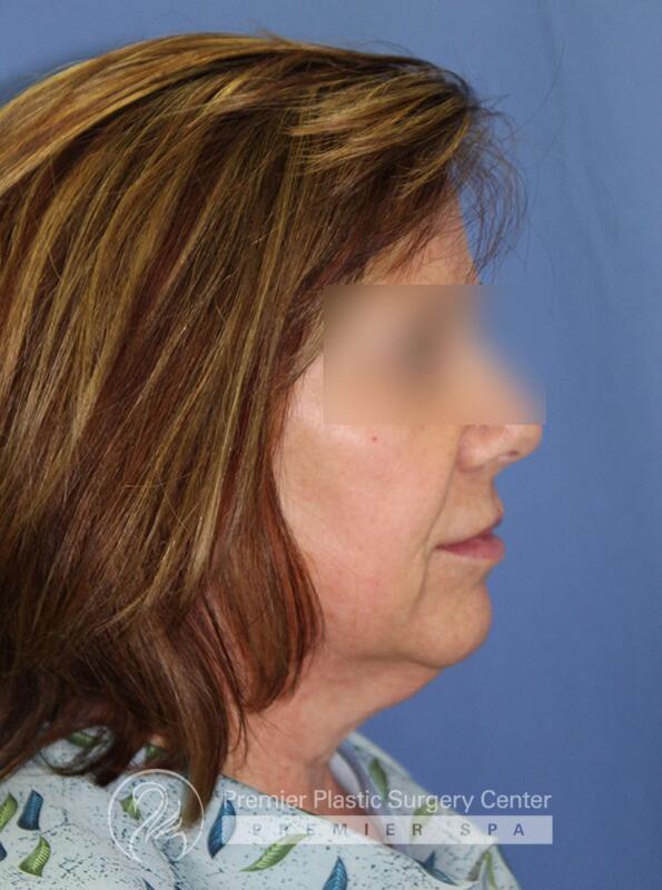 Neck Rejuvenation Before & After Image