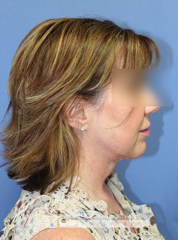 Neck Rejuvenation Before & After Image