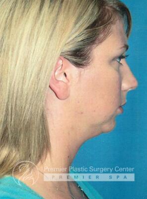 Neck Rejuvenation Before & After Image