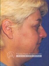 Neck Rejuvenation Before & After Image