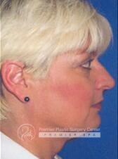 Neck Rejuvenation Before & After Image