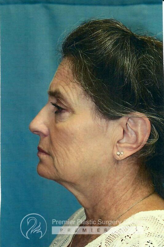 Neck Rejuvenation Before & After Image