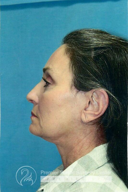 Neck Rejuvenation Before & After Image