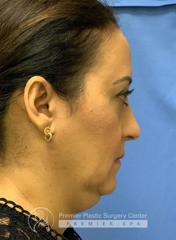 Neck Rejuvenation Before & After Image