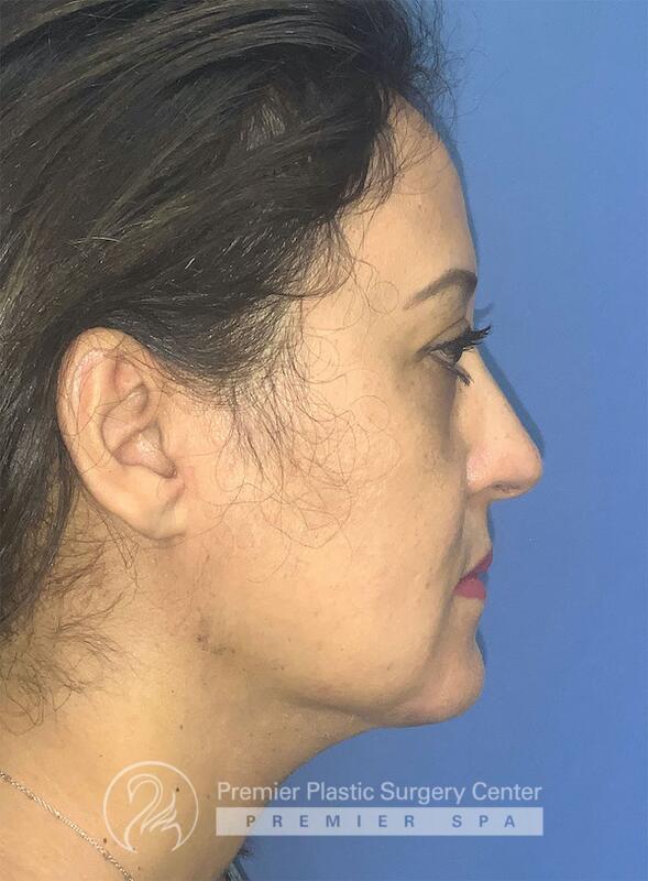 Neck Rejuvenation Before & After Image