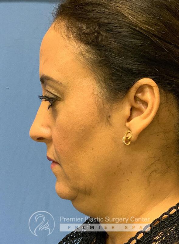 Neck Rejuvenation Before & After Image