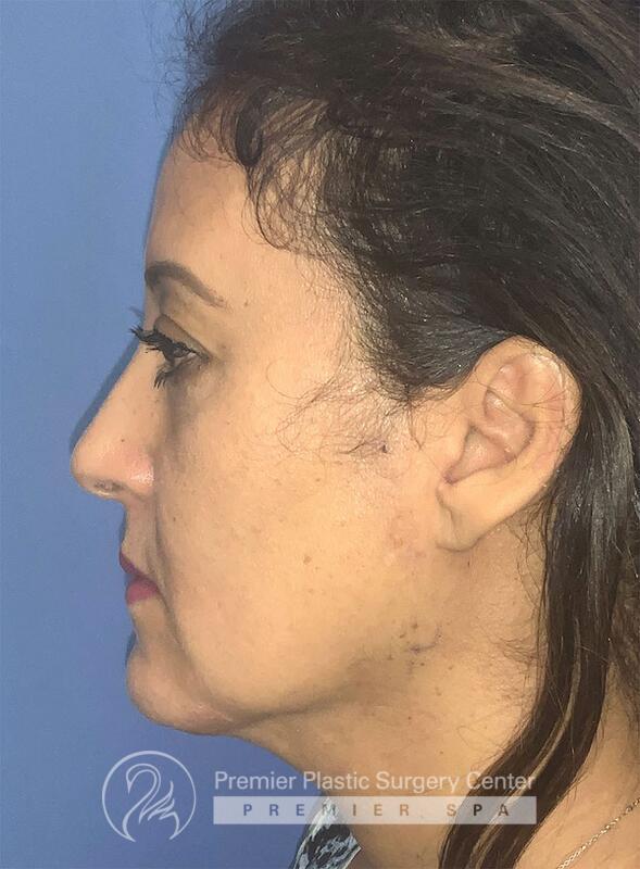 Neck Rejuvenation Before & After Image