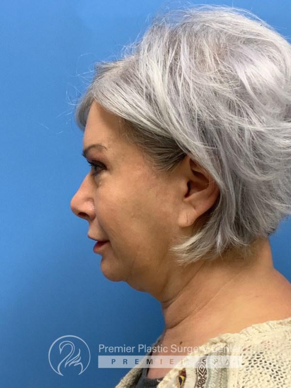 Neck Rejuvenation Before & After Image