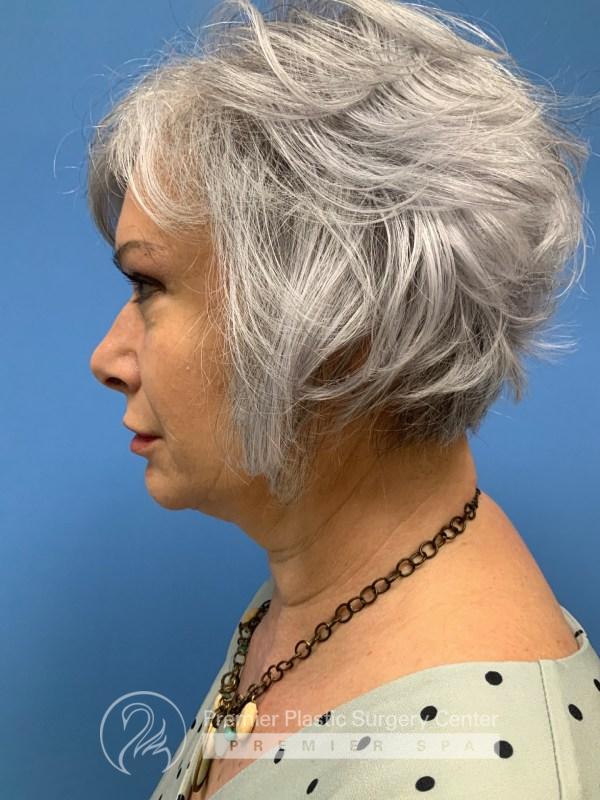 Neck Rejuvenation Before & After Image