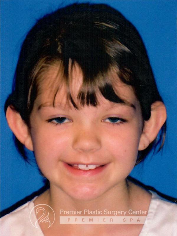 Otoplasty Before & After Image