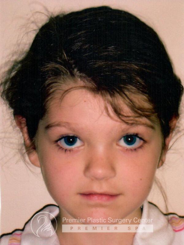 Otoplasty Before & After Image