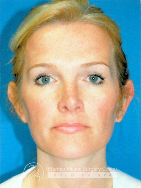 Otoplasty Before & After Image