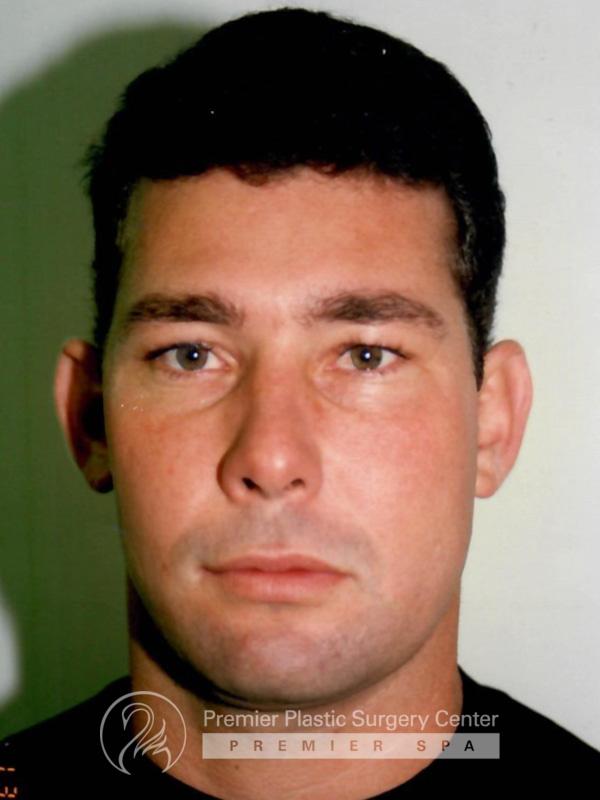 Otoplasty Before & After Image