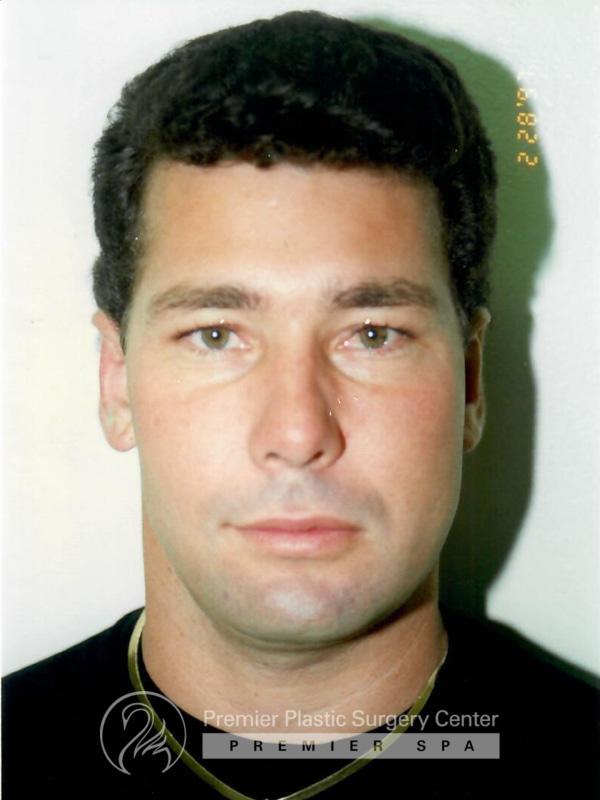 Otoplasty Before & After Image