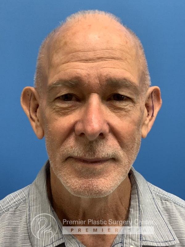 Otoplasty Before & After Image