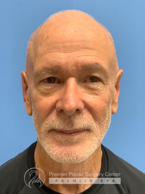 Otoplasty Before & After Image