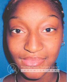 Rhinoplasty Before & After Image
