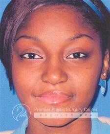 Rhinoplasty Before & After Image