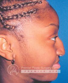 Rhinoplasty Before & After Image