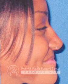 Rhinoplasty Before & After Image