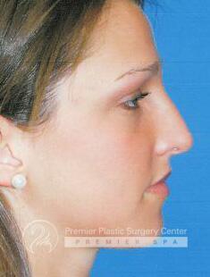 Rhinoplasty Before & After Image