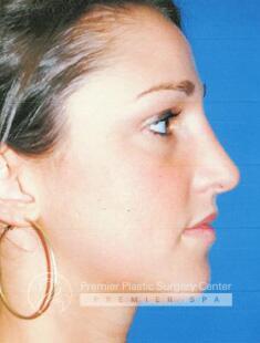Rhinoplasty Before & After Image