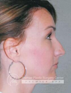 Rhinoplasty Before & After Image