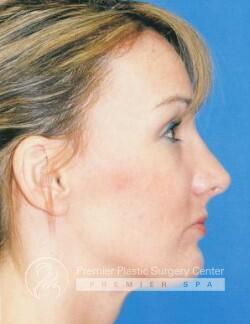 Rhinoplasty Before & After Image