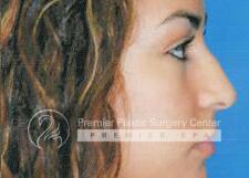 Rhinoplasty Before & After Image