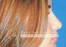 Rhinoplasty Before & After Image