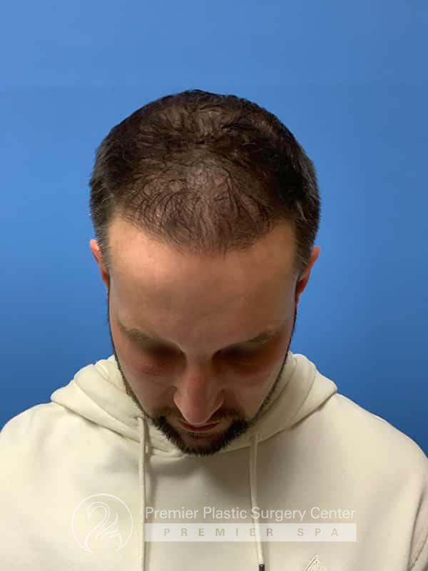 Neograft Hair Transplant Before & After Image