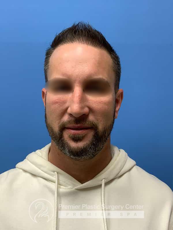 Neograft Hair Transplant Before & After Image