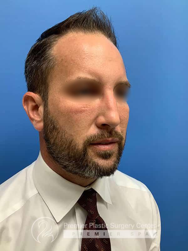 Neograft Hair Transplant Before & After Image
