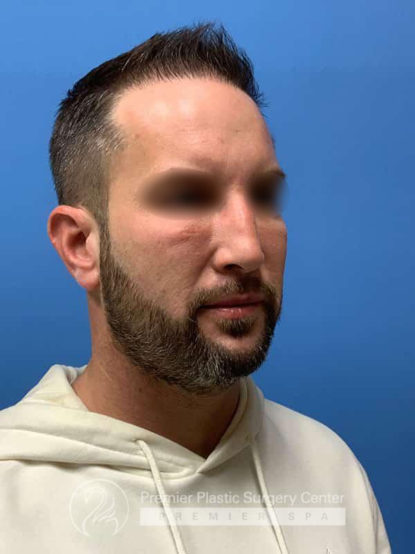 Neograft Hair Transplant Before & After Image