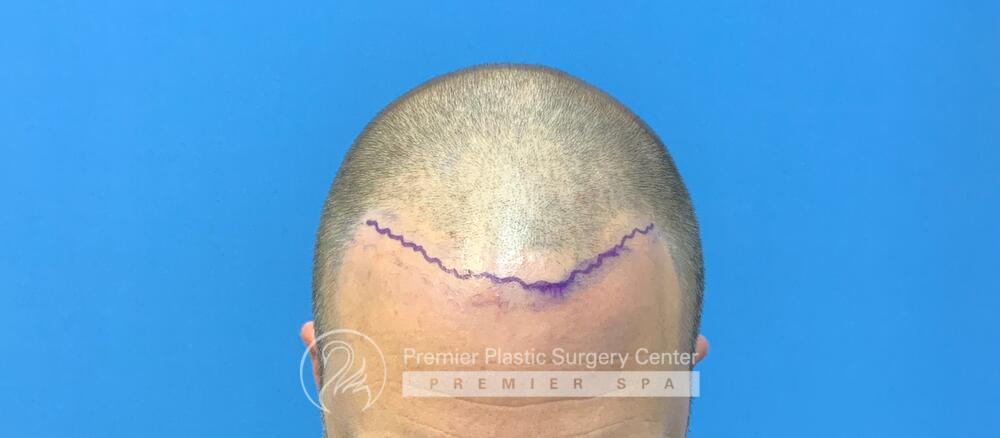 Neograft Hair Transplant Before & After Image