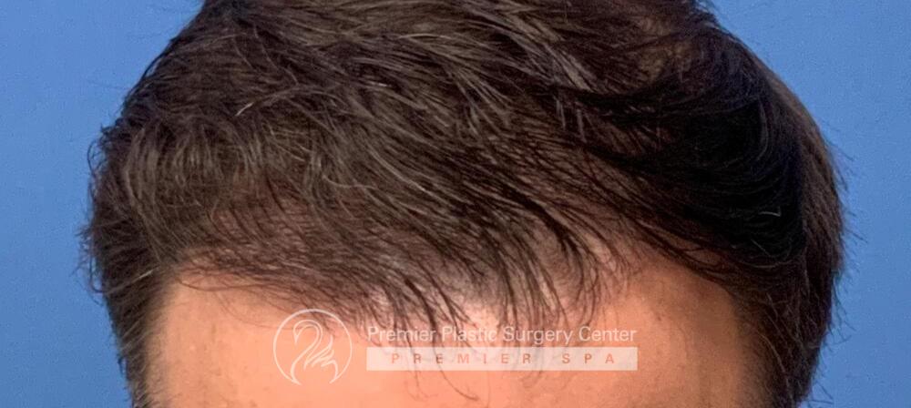 Neograft Hair Transplant Before & After Image