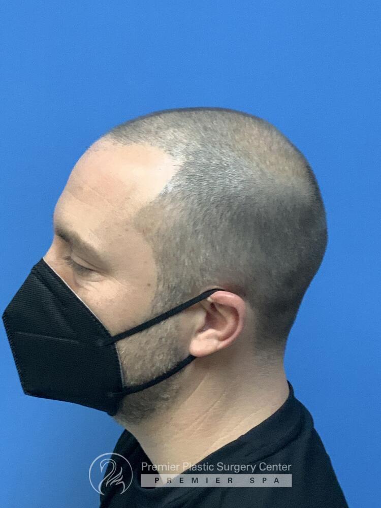 Neograft Hair Transplant Before & After Image