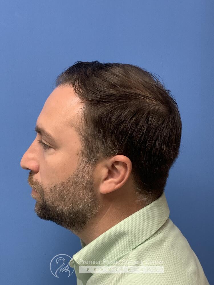 Neograft Hair Transplant Before & After Image
