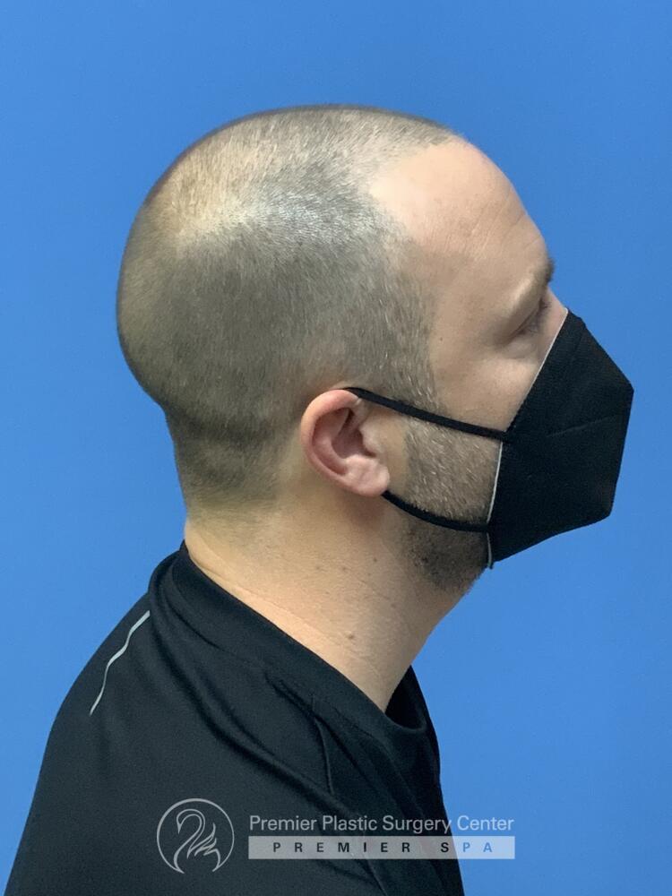 Neograft Hair Transplant Before & After Image