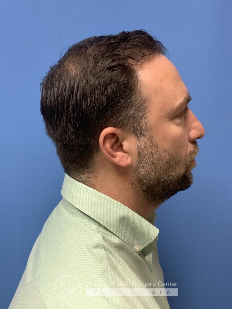 Neograft Hair Transplant Before & After Image