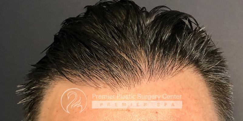 Neograft Hair Transplant Before & After Image