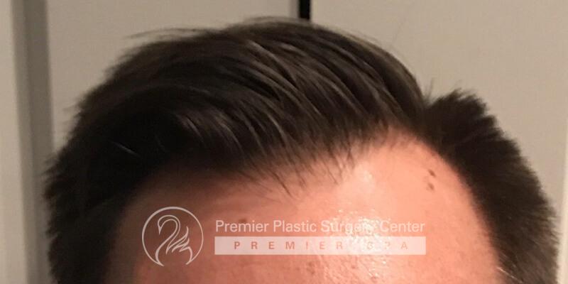 Neograft Hair Transplant Before & After Image