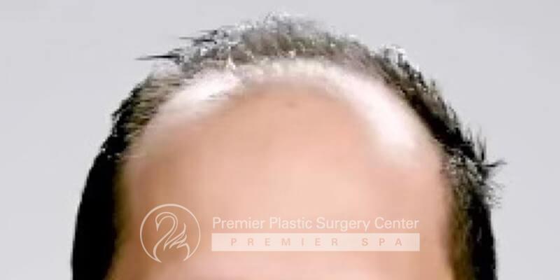 Neograft Hair Transplant Before & After Image