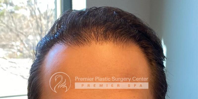 Neograft Hair Transplant Before & After Image